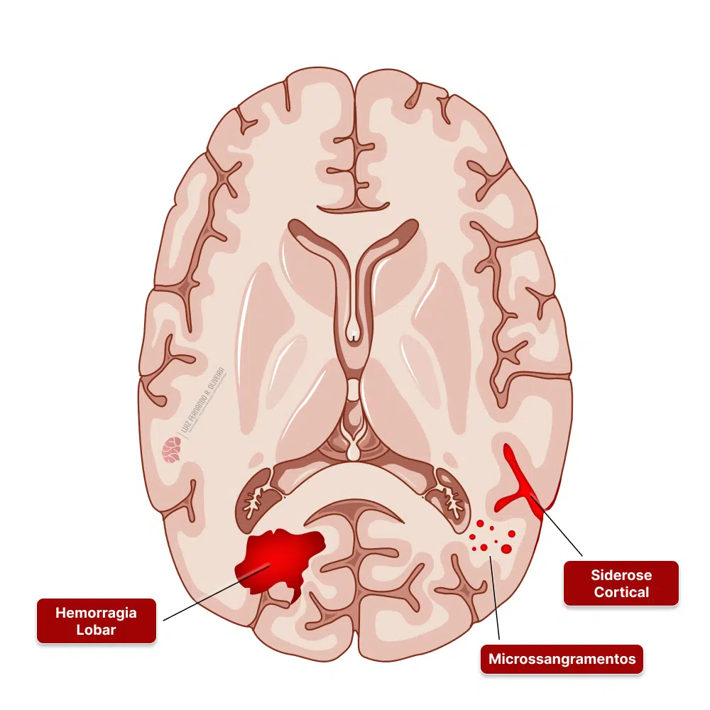 Hemorragia Cerebral AVC Hemorrágico Sintomas causas tratamentos