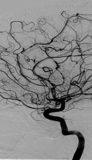 angiografia cerebral