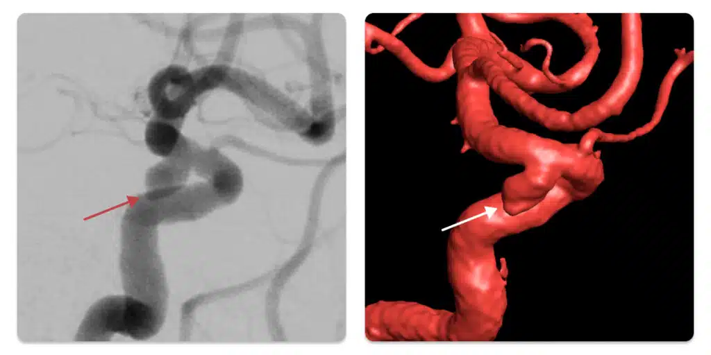 Angiografia digital e reconstrução 3D com aneurisma.