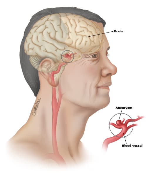 Aneurismas cerebrais são dilatações nos vasos do cérebro. Podem crescre e sangrar.