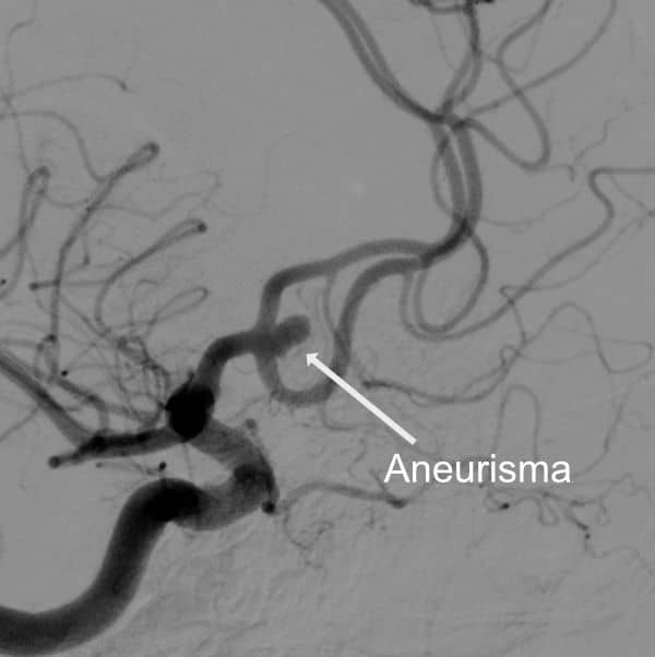 Aneurismas podem ser diagnosticados por angiografia cerebral.