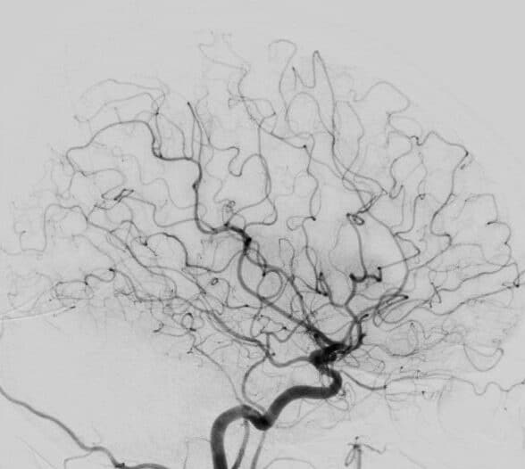 Exemplo de como os vasos sanguíneos são vistos em uma angiografia cerebral por cateterismo