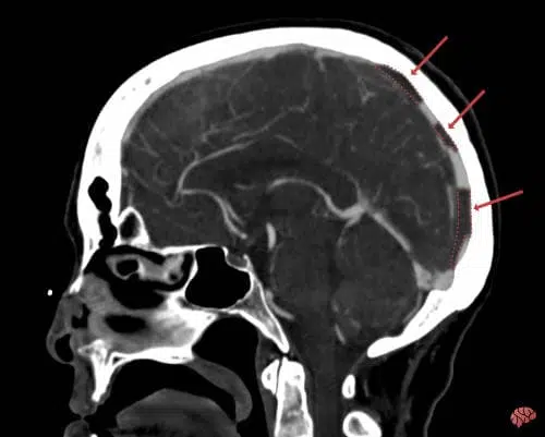 A tomografia e a ressonância podem diagnosticar a trombose venosa cerebral.
