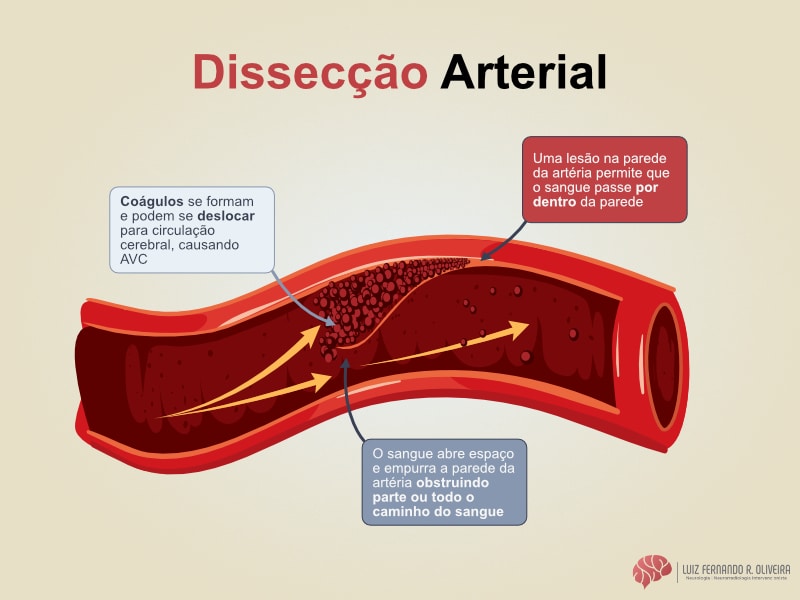 A dissecção de carótida e a dissecção da vertebral podem causar AVC.