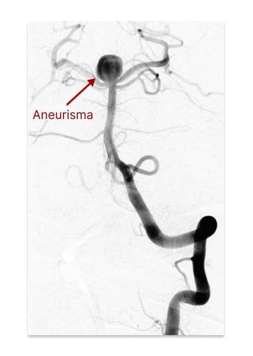 Angiografia com aneurisma da artéria basilar e uma seta identificando-o