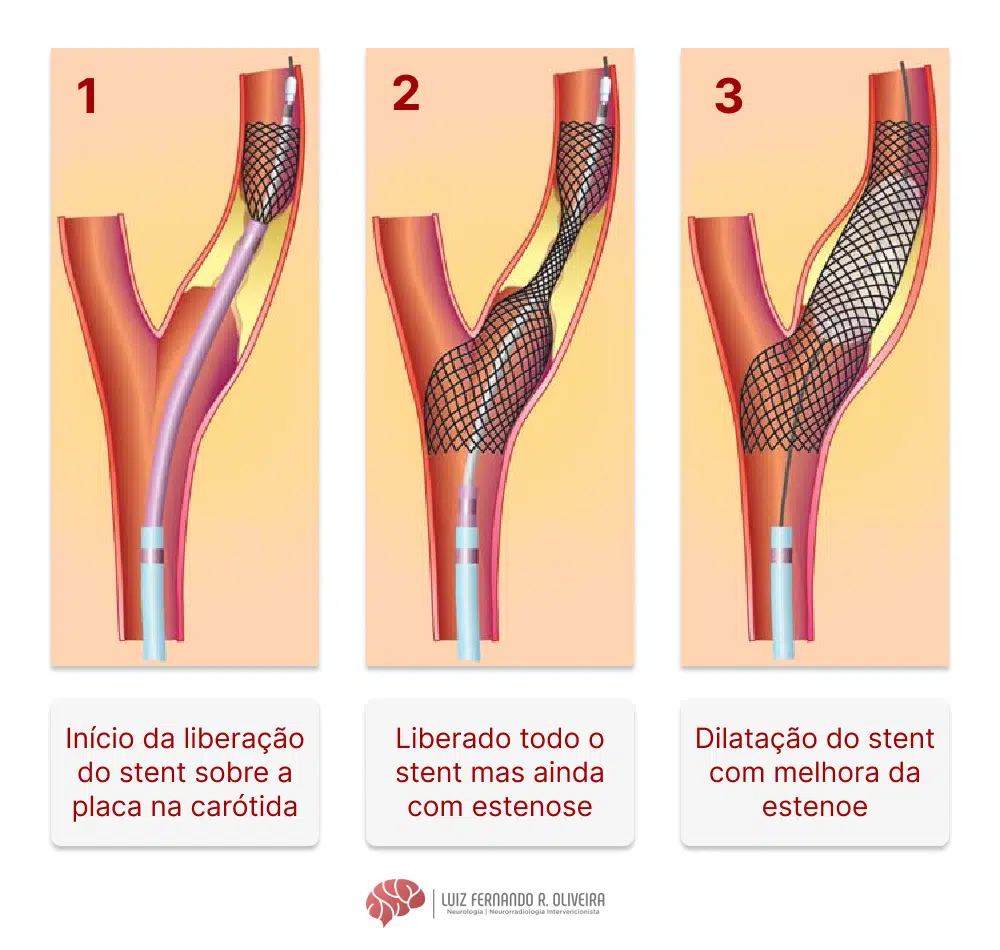 Passos da angioplastia com colocação de stent e dilatação com balão
