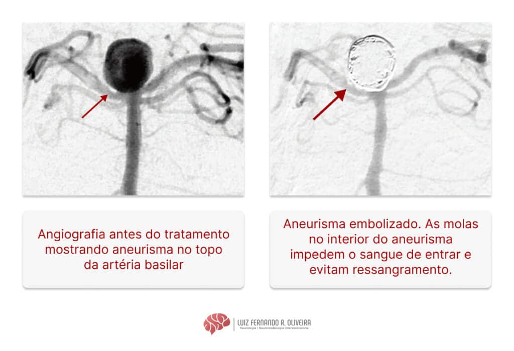 Exemplo de como é o tratamento endovascular por embolização do aneurisma cerebral roto.