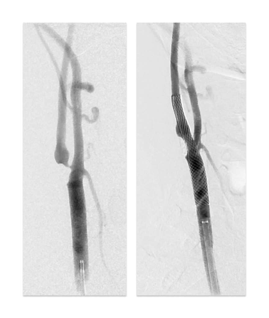 Imagens realizadas durante angioplastia de carótida mostrando resultado.