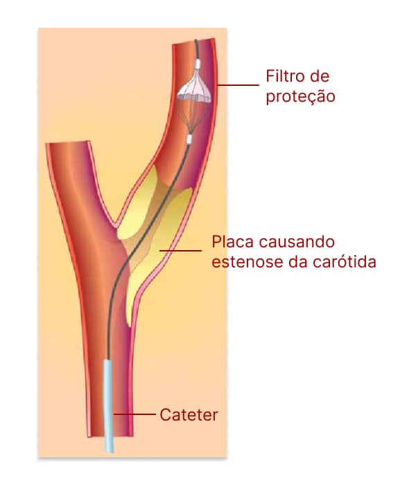 Esquema de placa de carótida com filtro de proteção durante angioplatias.