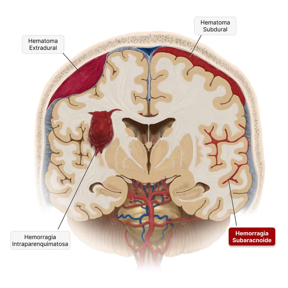 tipos de hemorragia cerebral e hemorragia subaracnoide