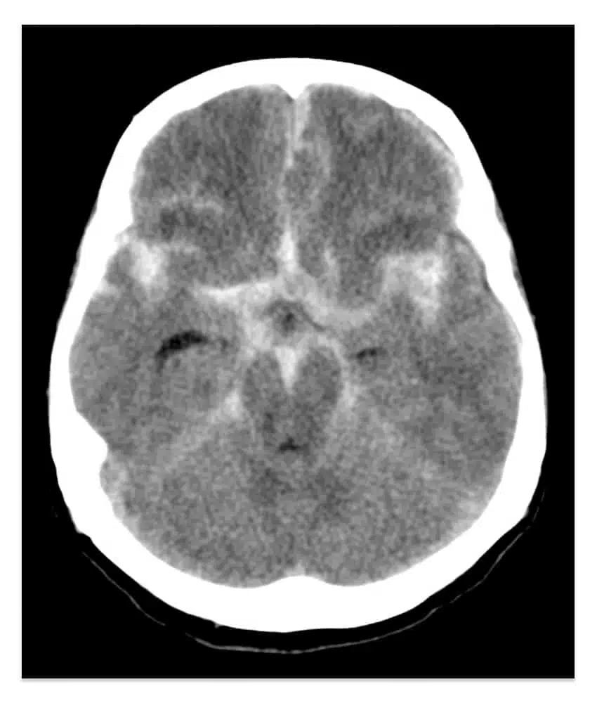 Tomografia de crânio evidenciando volumosa hemorragia subaracnoide por aneurisma rompido