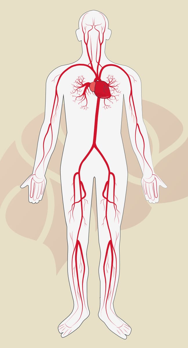 O tratamento endovascular é feito por dentro dos vasos sanguíneos