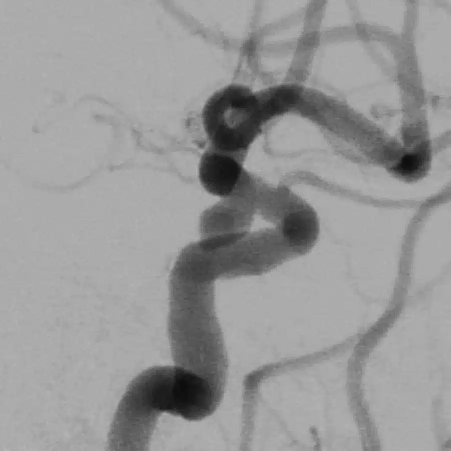 Angiografia com subtração digital com aneurisma de carótida interna