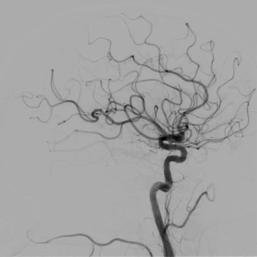 angiografia cerebral com subtração digital