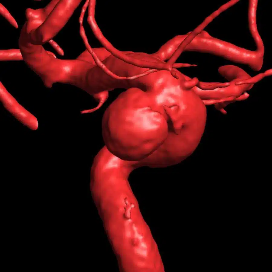 Angiografia 3D com aneurisma de carótida interna oftálmica