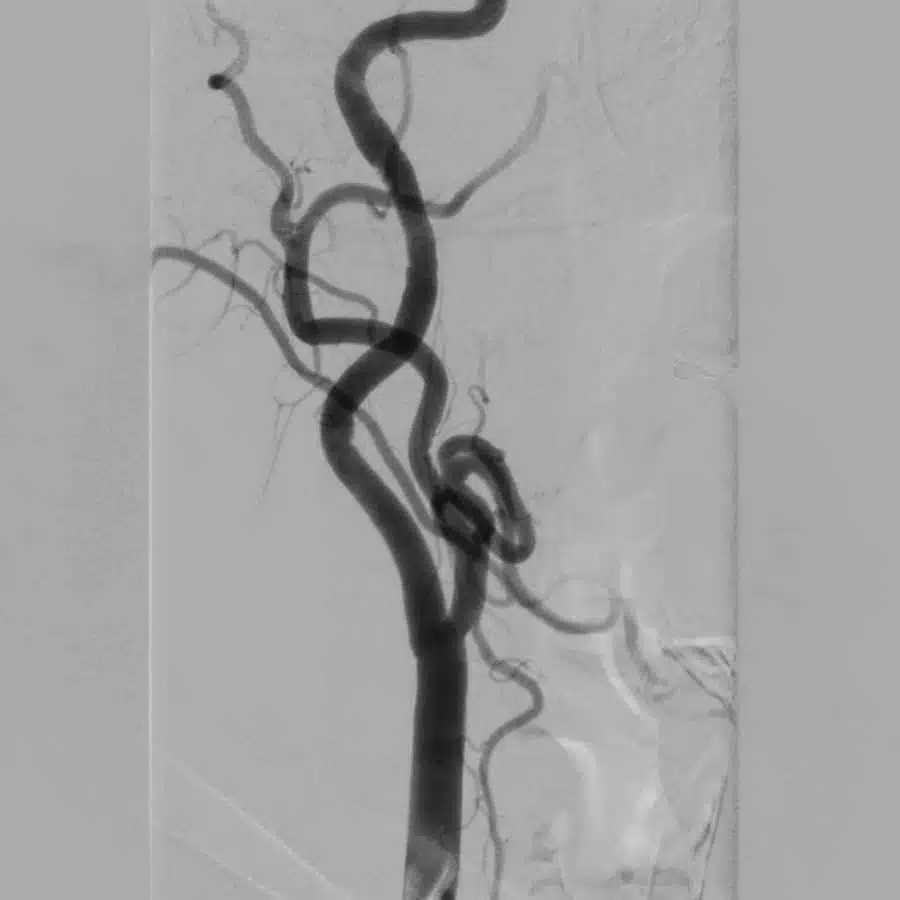 Angiografia cerebral de 4 vasos