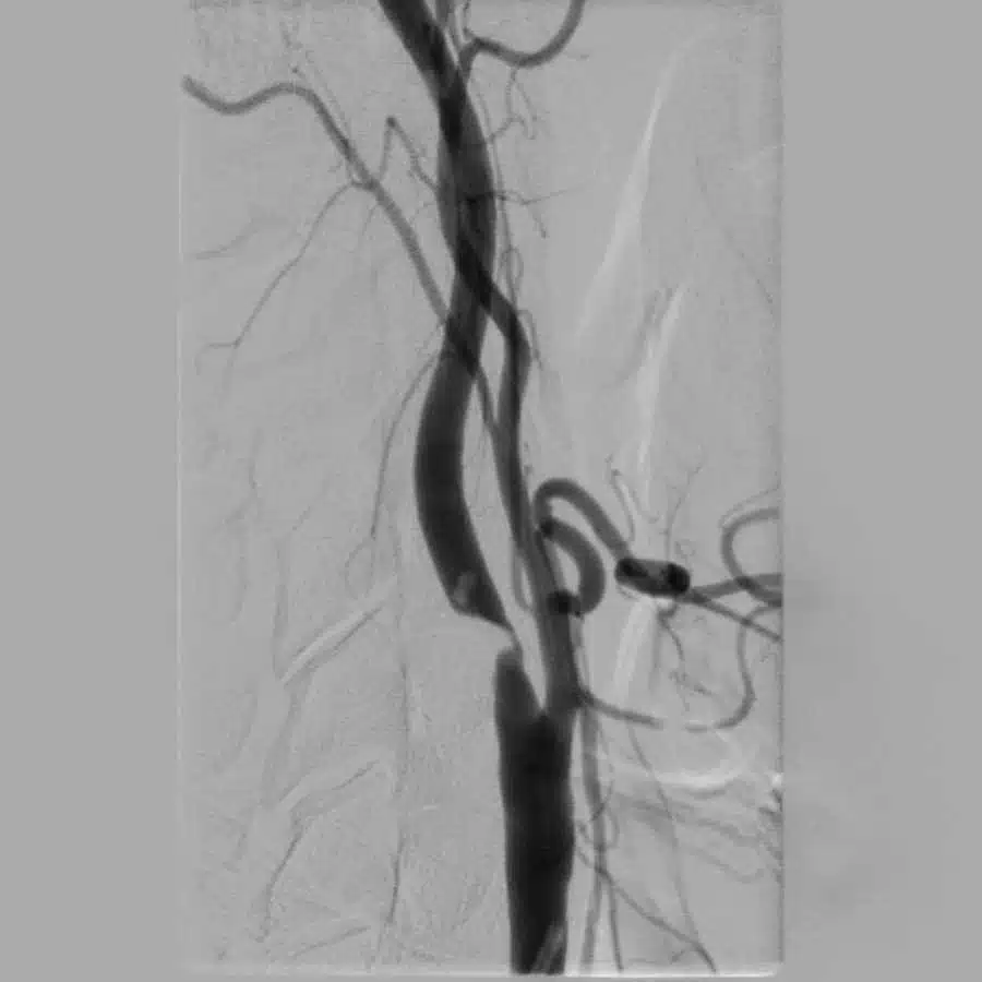 angiografia cerebral com estenose de carótida interna