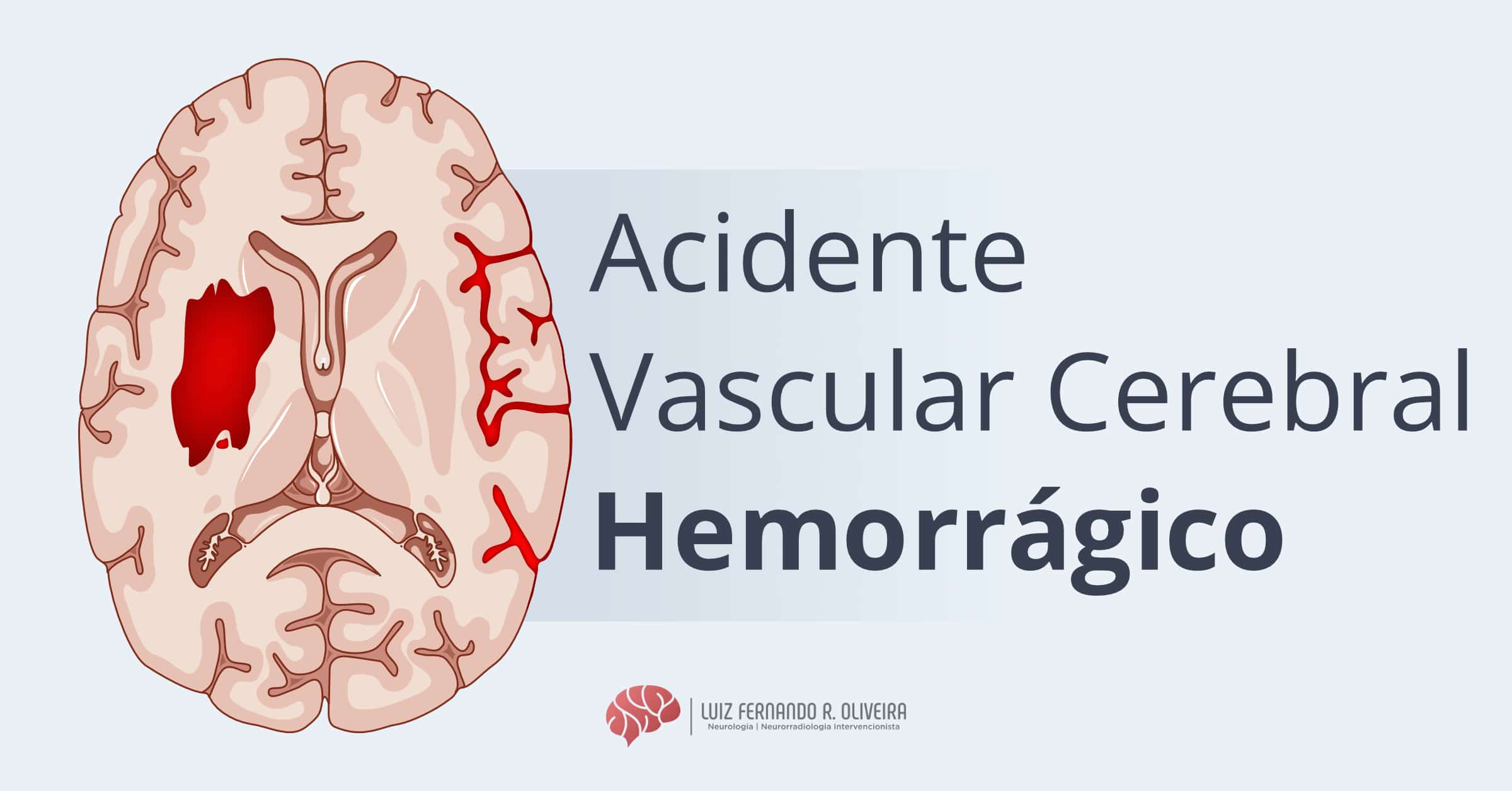 Hemorragia Cerebral: AVC Hemorrágico - Sintomas, causas, tratamentos