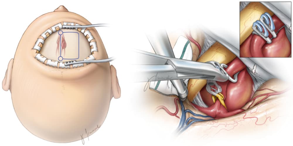Na cirurgia, clipes são colocados em volta do aneurisma.