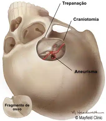 Craniotomia para tratamento de aneurisma.