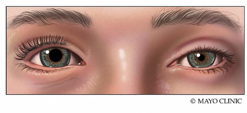 Disseção de carótida pode causar queda de pálpebra e constricção da pupila.
