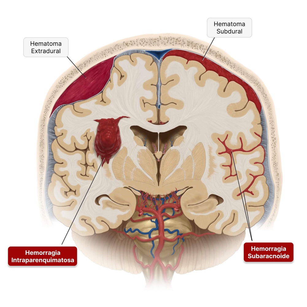 Hemorragia Cerebral: AVC Hemorrágico - Sintomas, causas, tratamentos