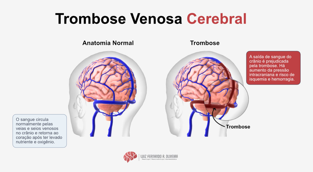 Infográfico mostrando como é a trombose venosa cerebral
