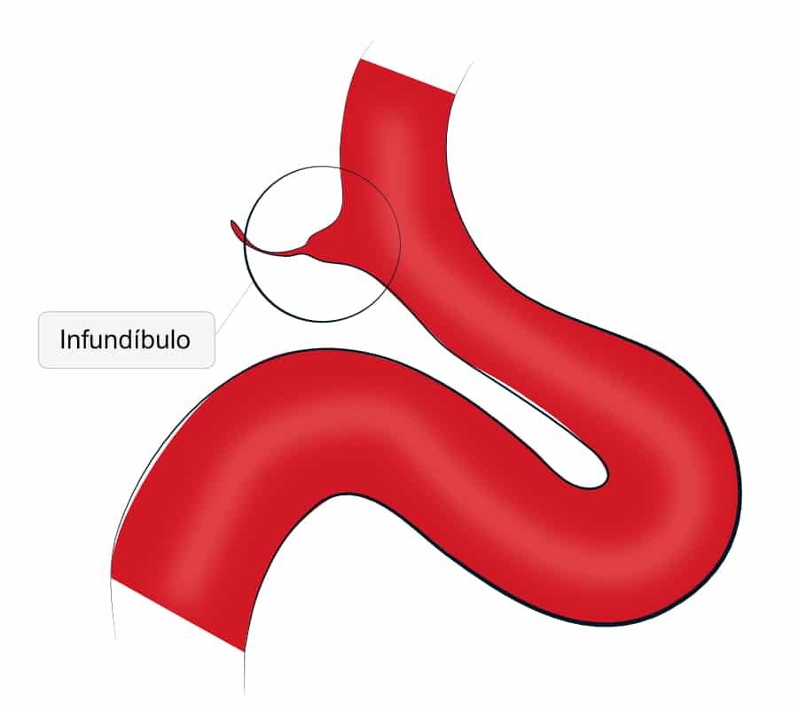 Ilustração de uma dilatação infundibular com origem na carótida interna, mostrando o seu formato trinagular e a origem de um vaso na sua ponta.