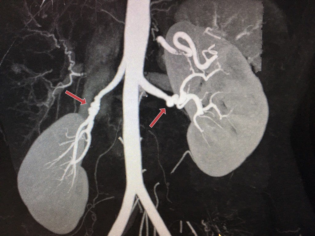 Angiotomografia mostra irregularidades e dilatação da artéria renal por fibrodisplasia