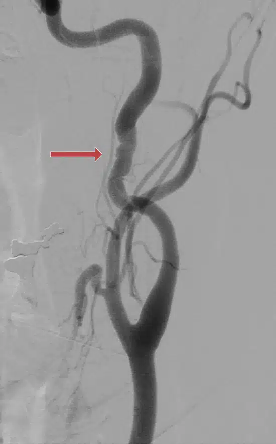 Angiografia digital de carótida mostrando displasia fibromuscular.