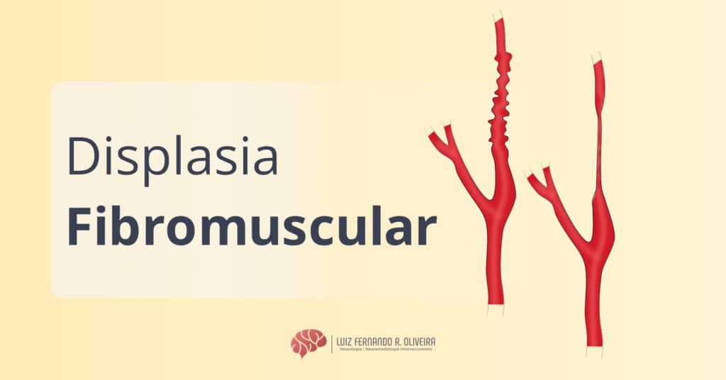 Título de artigo sobre displasia fibromuscular com ilustração de artérias carótidas com a doença