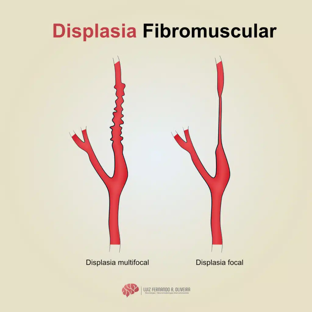 Ilustração dos diferentes tipos de displasia fibromuscular de carótidas: focal e multifocal