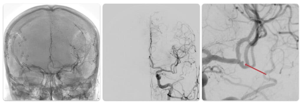 Image mostra angiogarfia com subtração digital de aneurisma