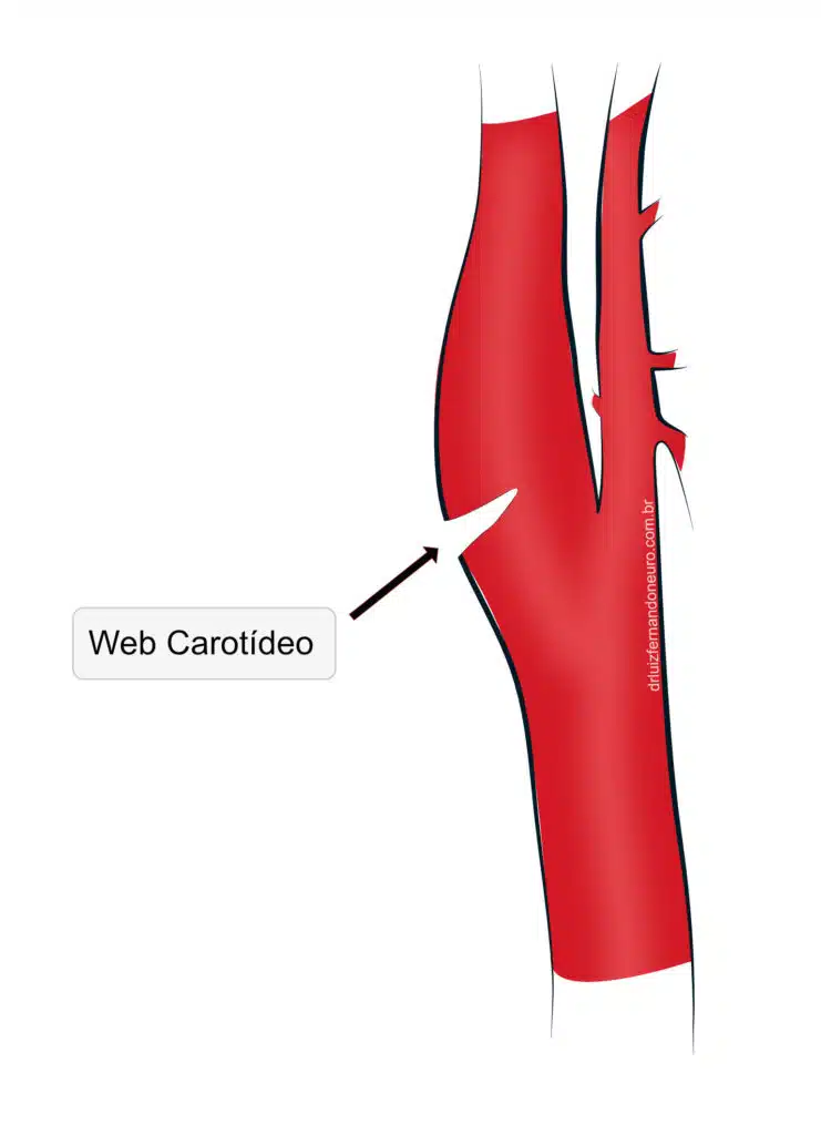 Ilustração de um web carotídeo, que é uma membrana na carótida interna que provoca avc