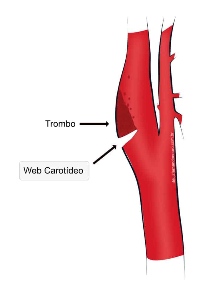 Ilustração de um trombo se formando sobre um web carotídeo