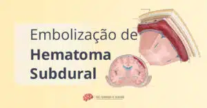 Titulo de artigo sobre Embolização da Artéria Meníngea média para Tratamento do Hematoma Subdural mostrando uma ilustração do hematoma