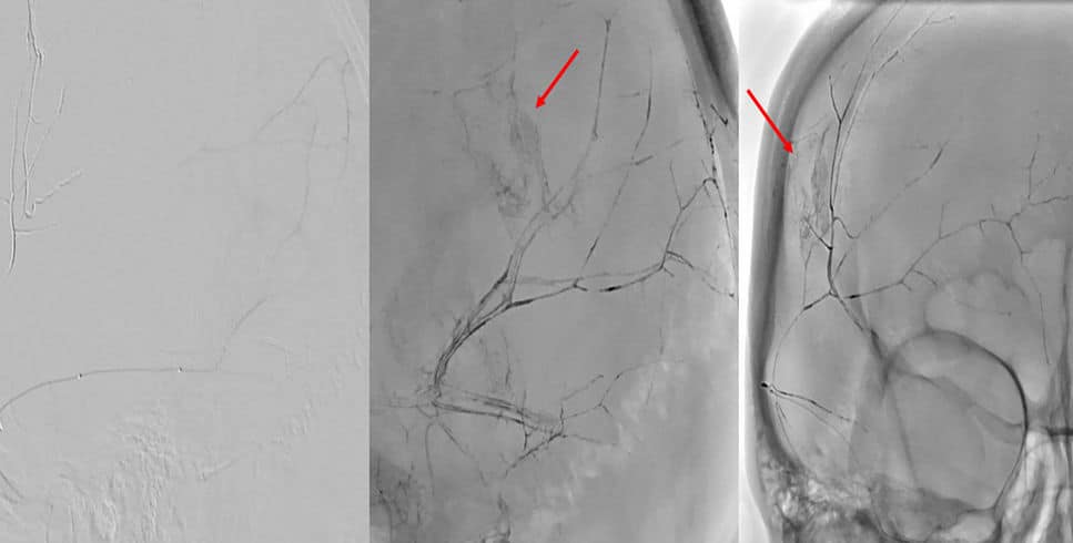 Demonstração da embolização de hematoma subdural